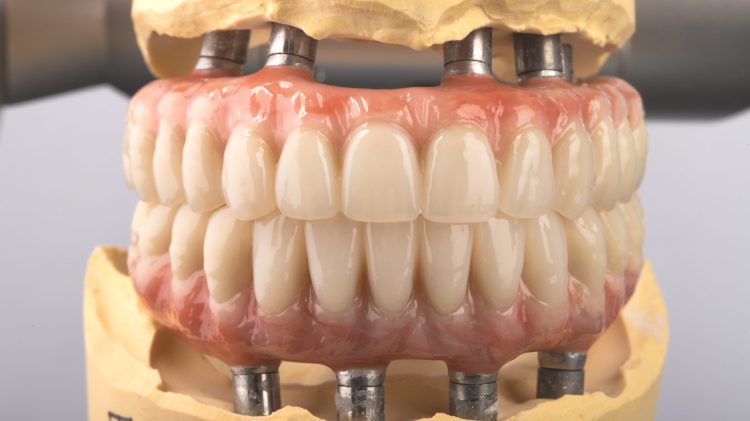 درمان بی دندانی کامل با ایمپلنت دندان