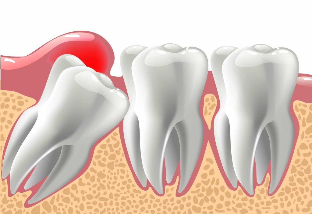 علل بروز دندان نهفته چیست؟