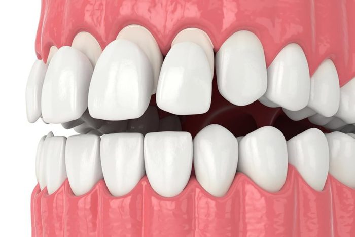 دلایل لق شدن کامپوزیت دندان