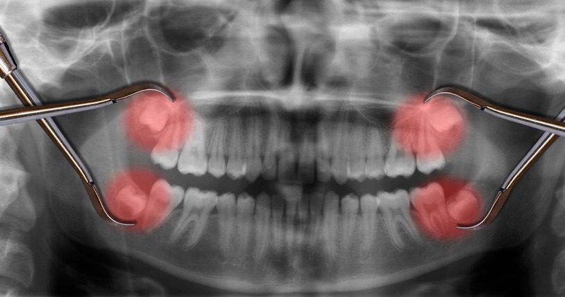 علائم و عوارض دندان نهفته چیست؟