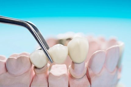 مزایا و معایب ایمپلنت فوری دندان و چگونگی انجام