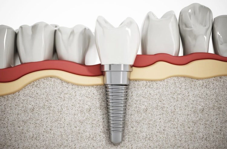 مراحل قالب گیری ایمپلنت دندان