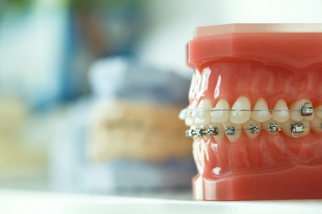 انواع روش های انجام ارتودنسی دندان