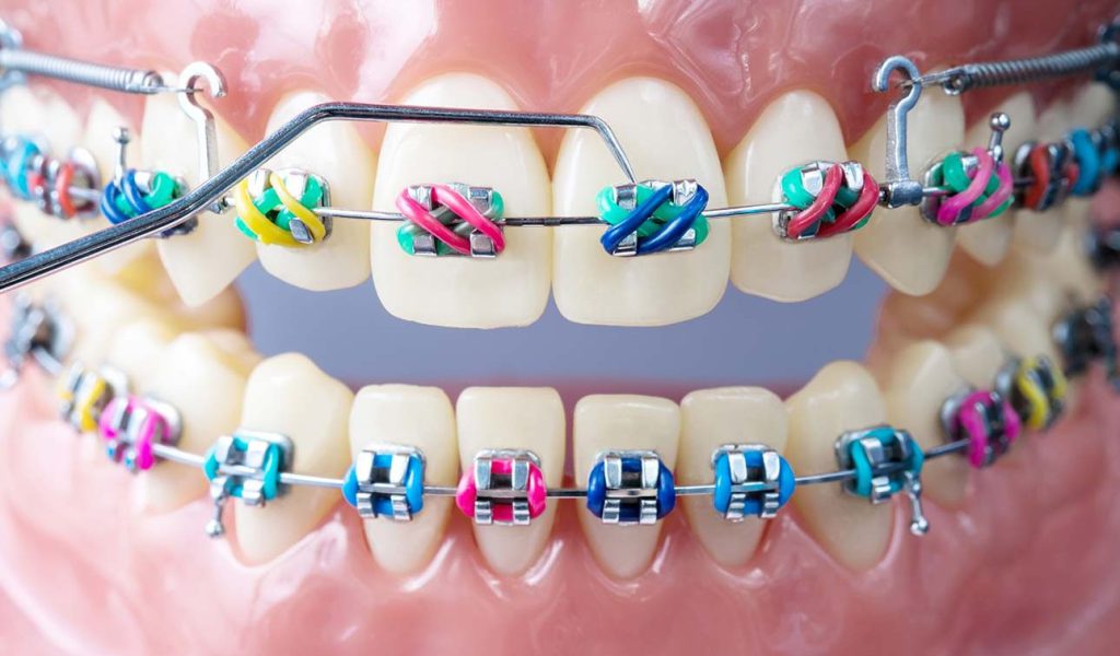 خدمات ارتودنسی برای زیبایی دندان