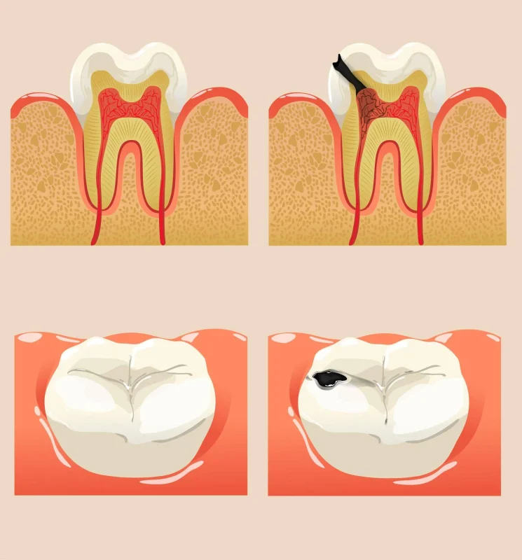 طول عمر بیلداپ دندان چقدر است؟