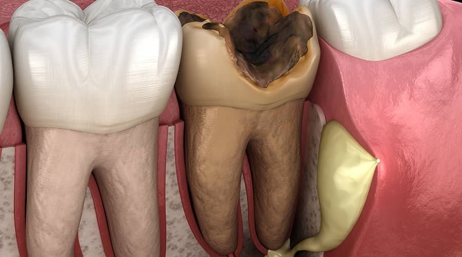 با علائم عفونت دندان پس از کشیدن چه کنیم؟