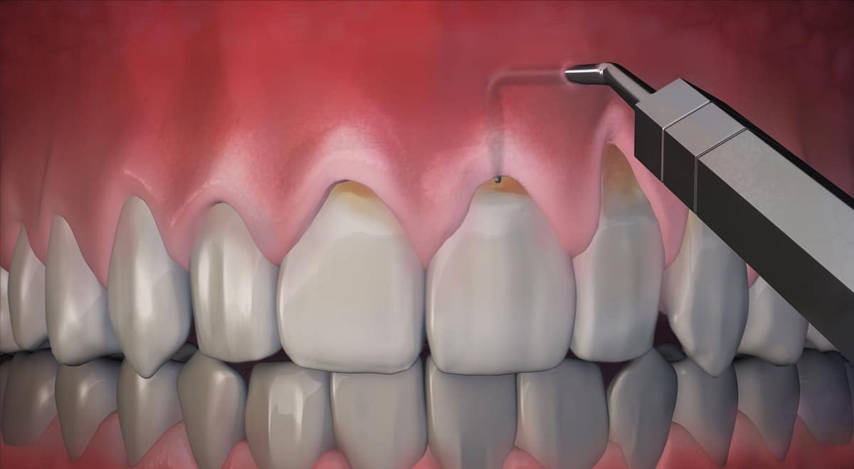جلوگیری از تحلیل رفتن لثه بعد از کشیدن دندان با ایمپلنت