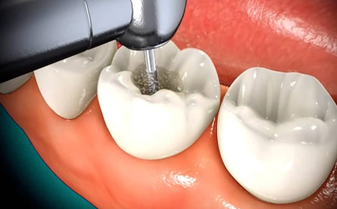 جلوگیری از عفونت پالپ دندان