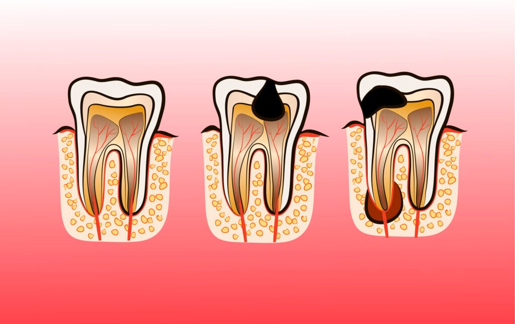 درمان لایه های ریشه دندان چگونه است؟