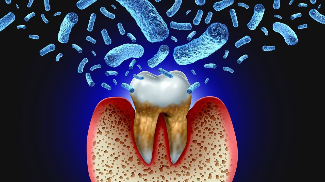 علائم عفونت دندان چیست؟