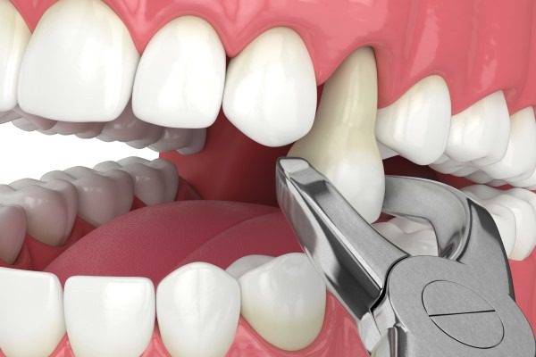 علت عفونت دندان پس از کشیدن