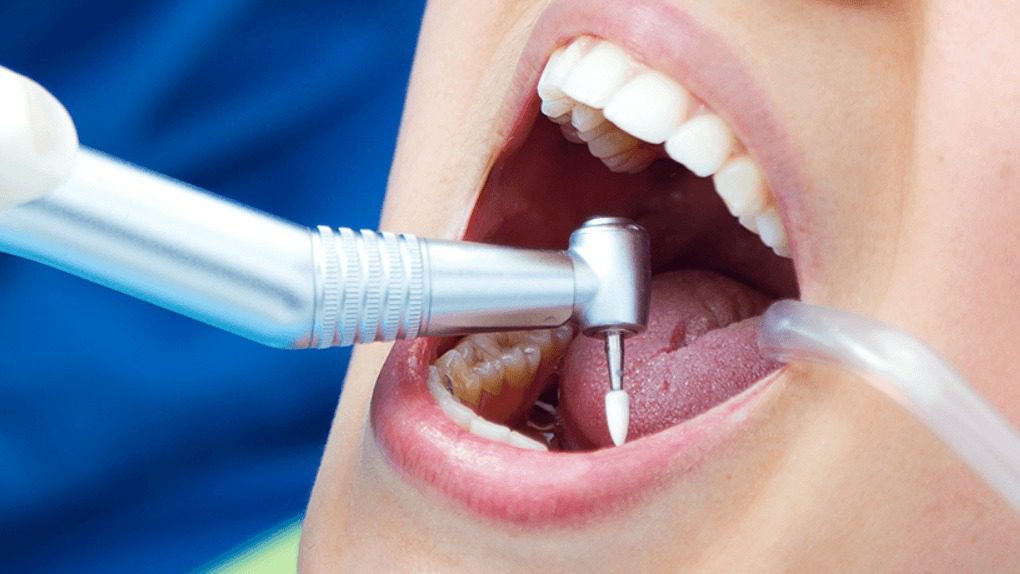 عصب کشی و پر کردن هم زمان دندان 