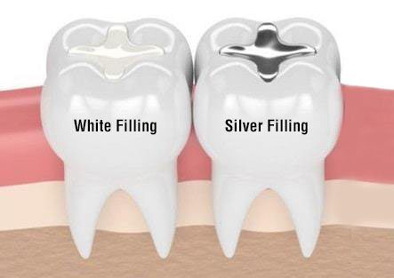 پرکردن دندان با مواد سیاه یا مواد سفید؛ آیا کامپوزیت بهتر از آملگام است؟