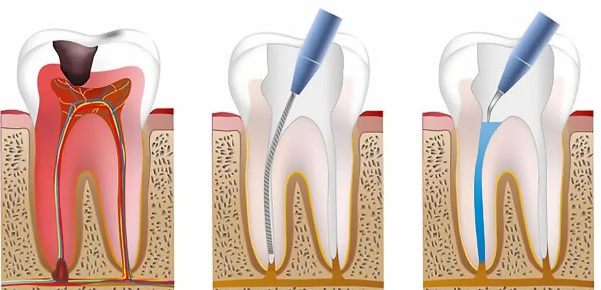 کانال و ریشه های دندان
